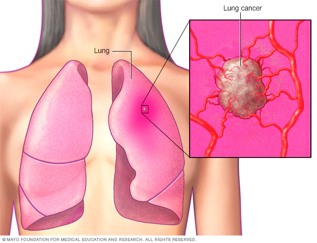 폐암의 초기 증상과 원인 알아보기 : 건강한 폐를 위한 지침