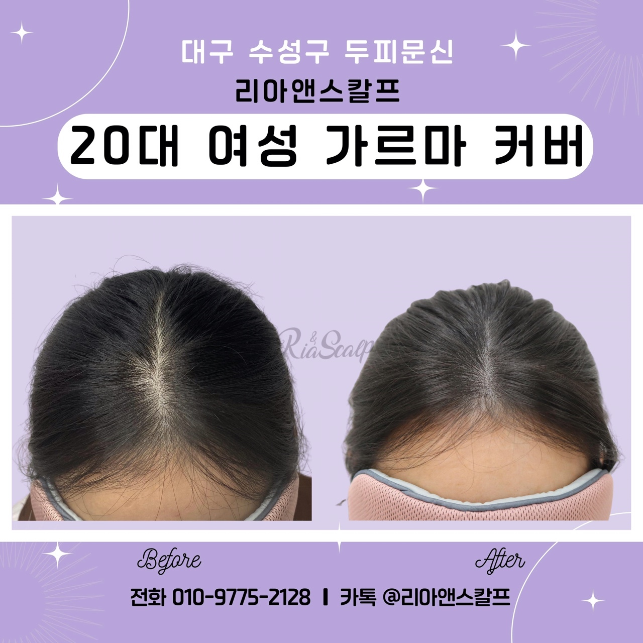  [대구 수성구 두피문신] 20대 가르마 커버/리아앤스칼프
