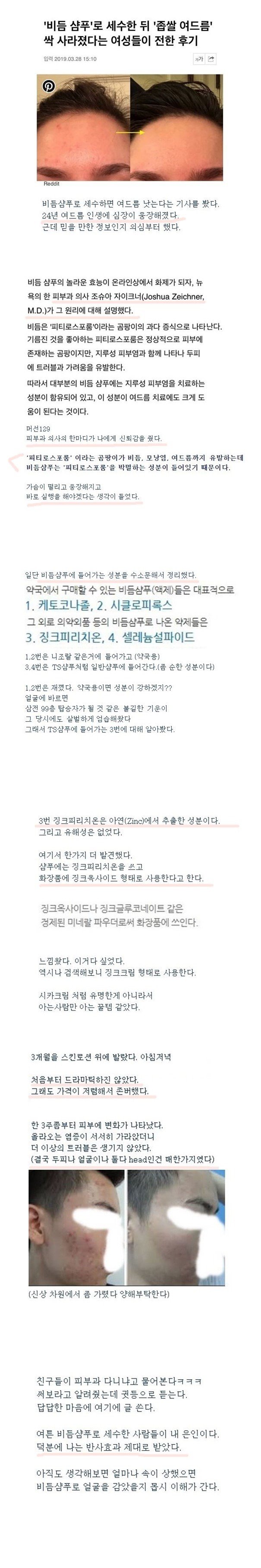 여드름에 효과있는 비듬샴푸의 의외의 효능 후기.JPG