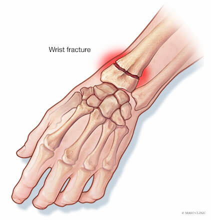 손목 골절 증상 및 재활운동 방법! : 콜레스 골절