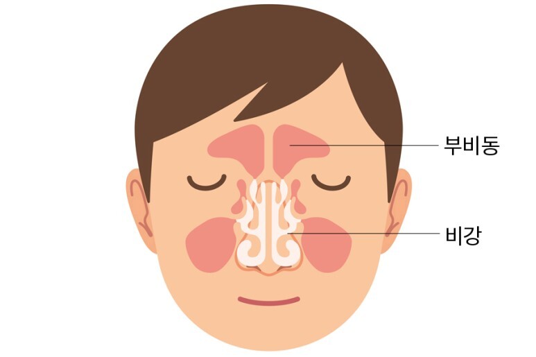 비염 이제 간단하게 치료 합시다!!