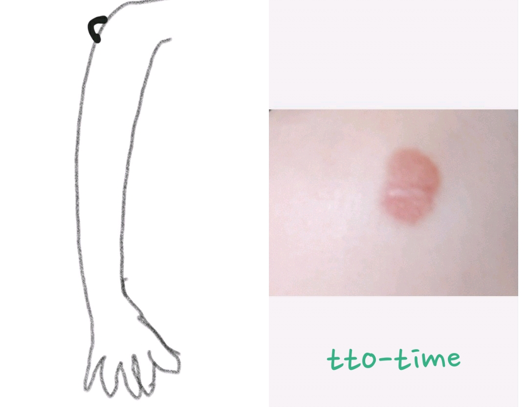 피지낭종제거후기(동네외과&대학병원피부과 비교)