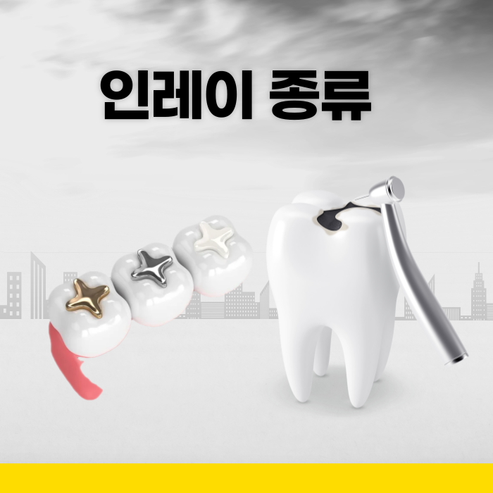  치과치료 인레이 종류, 내 선택은?