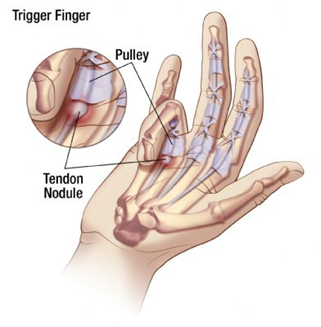 방아쇠 수지 증후군 을 치료하는 방법 - Trigger finger syndrome