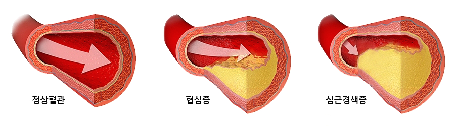  심장혈관질환 협심증