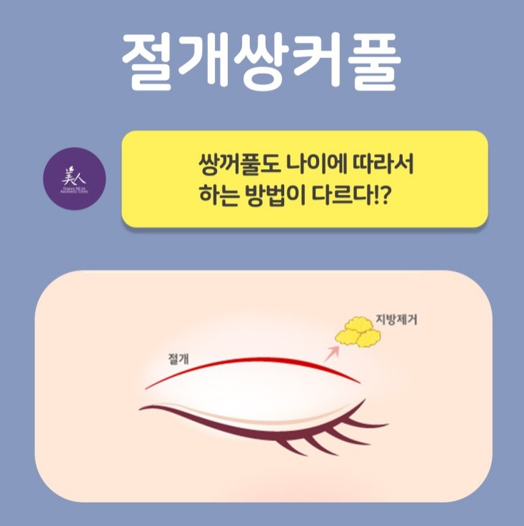  수원눈성형잘하는곳 : 눈처짐,눈꼬리처짐 없는 절개의 매력(#안검하수걱정마세요)