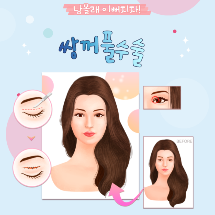  수원자연유착쌍꺼풀 하면서 눈매 교정