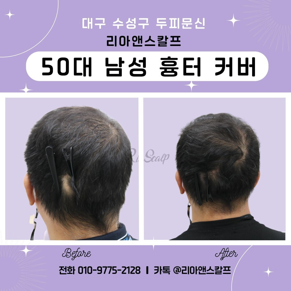  [대구수성구두피문신] 50대 남성 흉터커버/리아앤스칼프