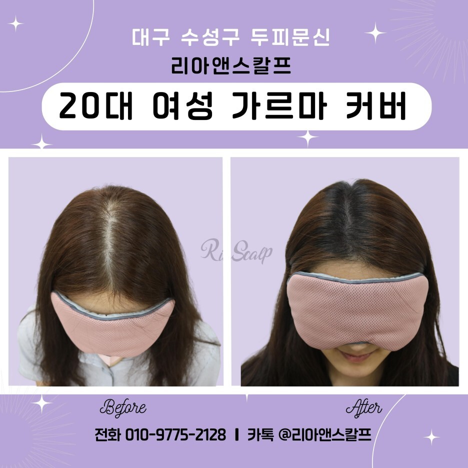 [대구수성구두피문신] 20대 여성 가르마 커버/리아앤스칼프
