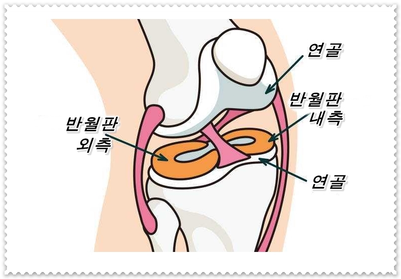  반월판 손상은 자연히 낫지 않는다!  무릎 통증의 원인과 증상, 치료법에 대해