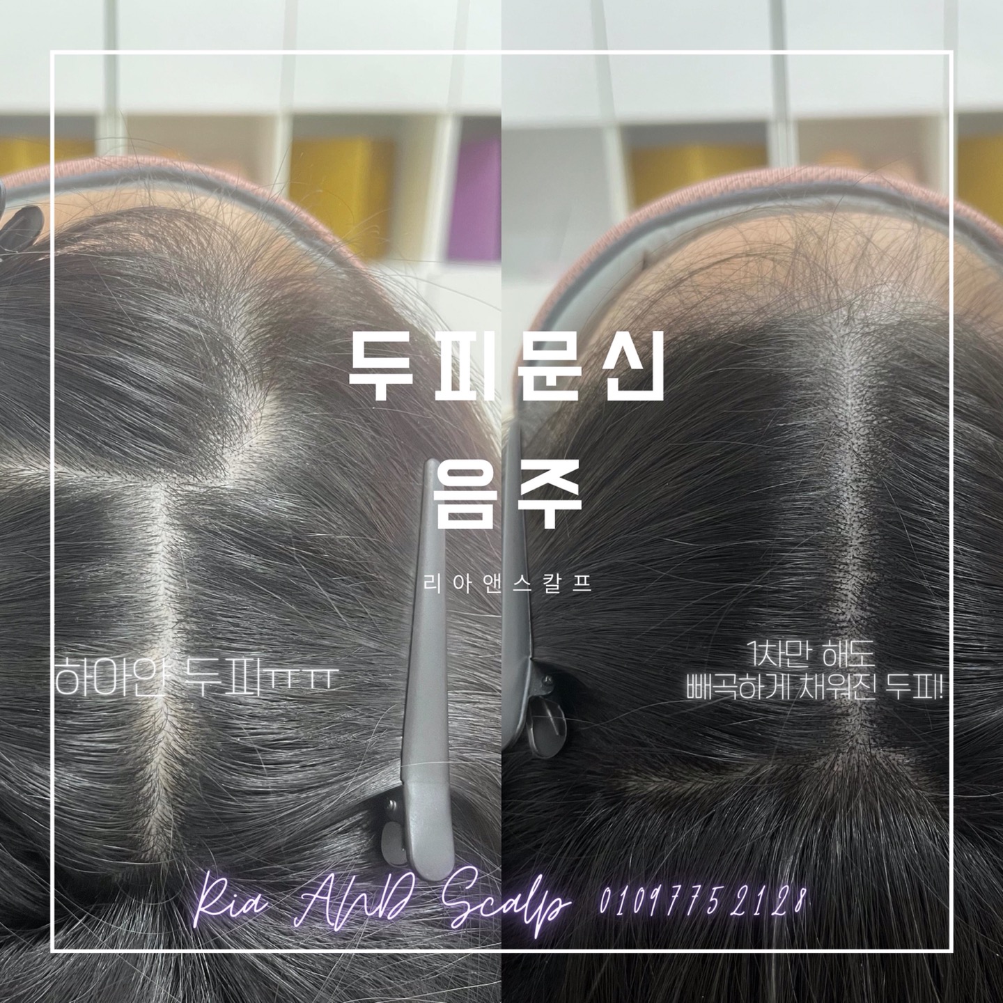  대구두피문신잘하는곳/리아앤스칼프/두피문신음주