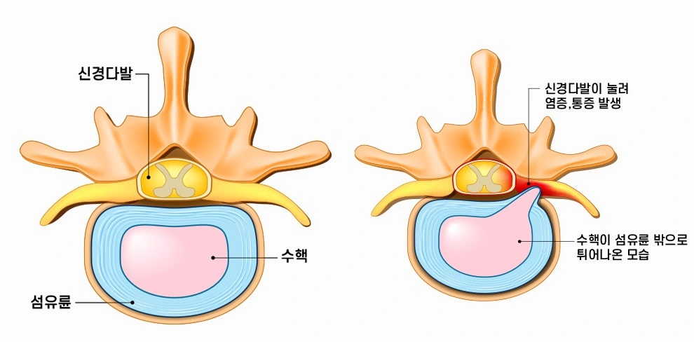  허리디스크 초기증상 6가지, 혹시 나도?