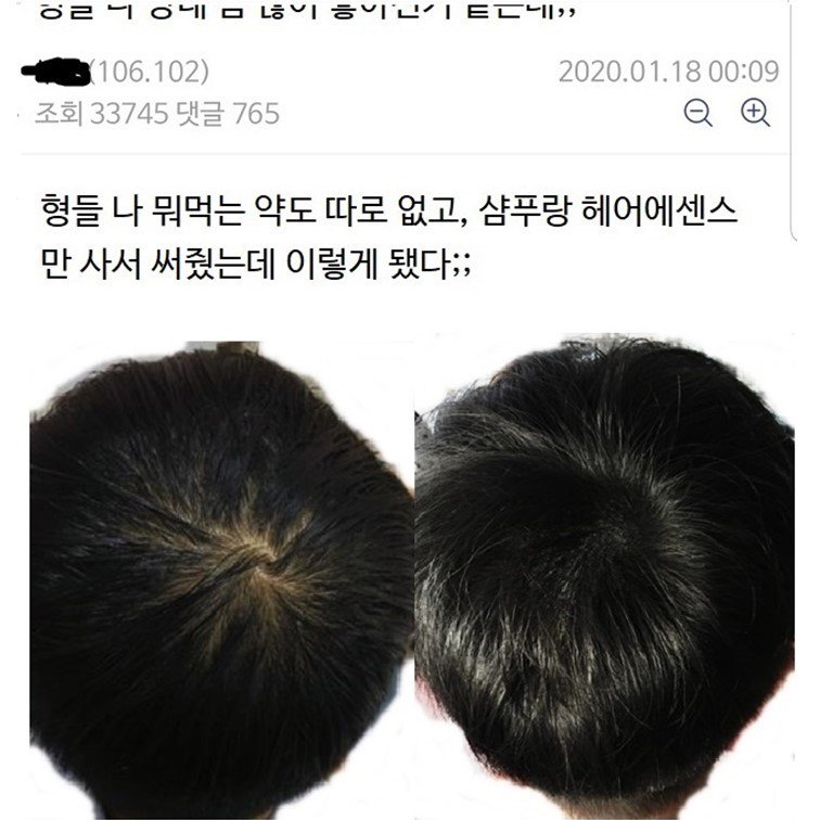 탈모갤 논란의 맥주효모 샴푸, 근황
