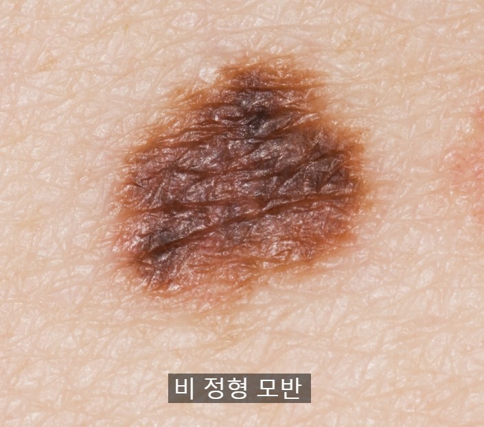  피부암 증상 및 예방방법