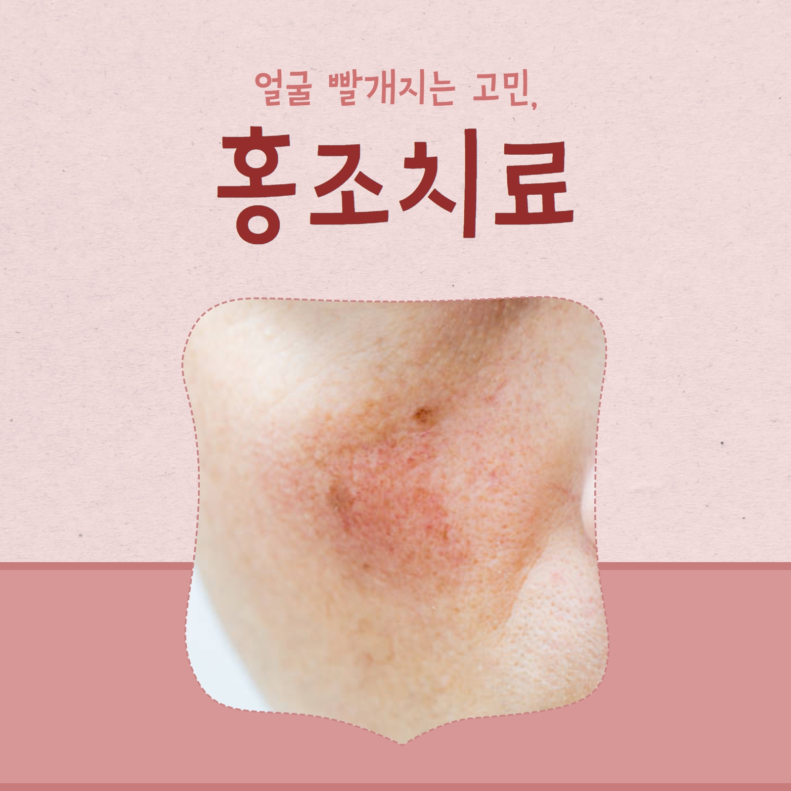  수원피부과 홍조치료로 얼굴 빨개지는 고민 해결!