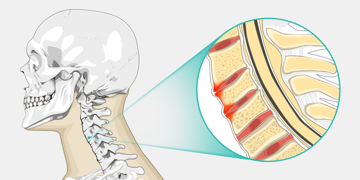  척추증 원인 증상 그리고 운동방법은 : Spondylosis
