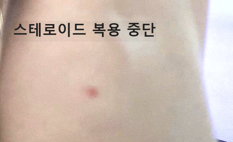 스테로이드부작용