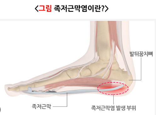 족저근막염 치료법