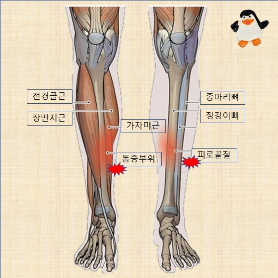 신스프린트-통증부위-근육위치