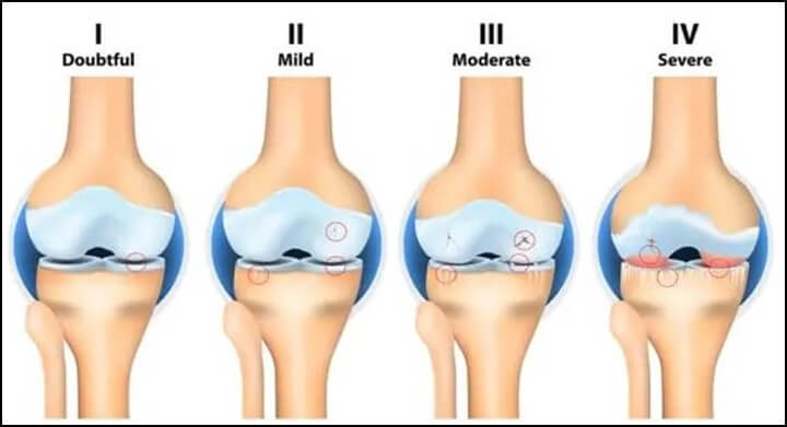 무릎 연골의 손상의 단계를 나타낸 그림