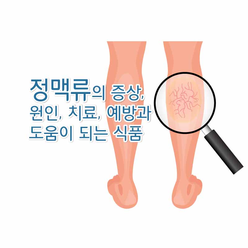 정맥류의 증상&#44; 원인&#44; 치료&#44; 예방과 도움이 되는 식품