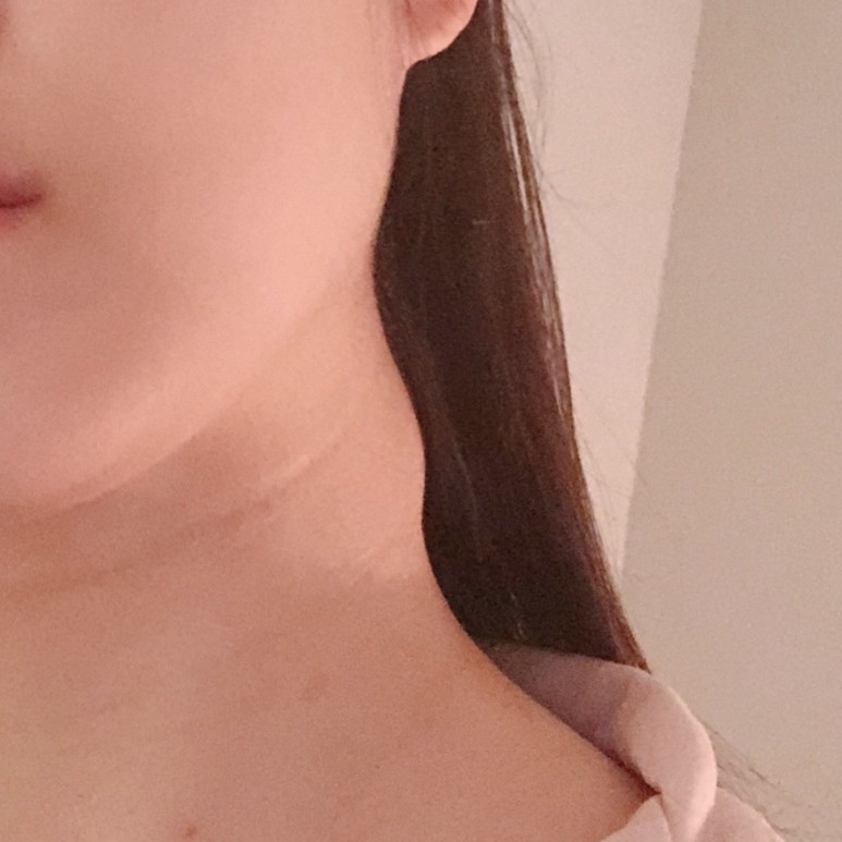 쇄골과 목에 멍울이 여러개 - 결국 대학병원 4