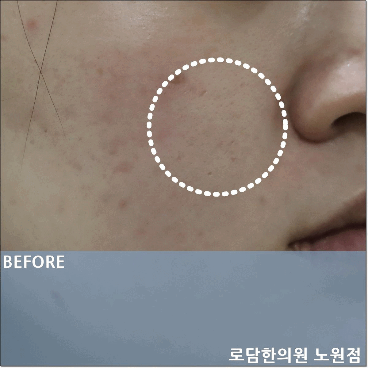  노원여드름흉터 제거 파인 자국 치료 과정 새살침