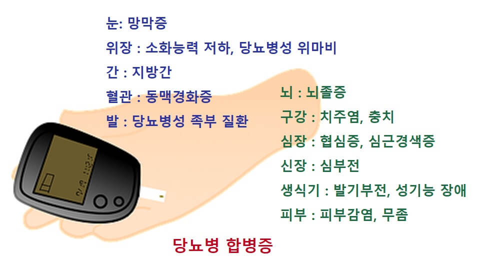  당뇨병 합병증. 당뇨병 초기에 잡아야 하는 당뇨병 합병증.