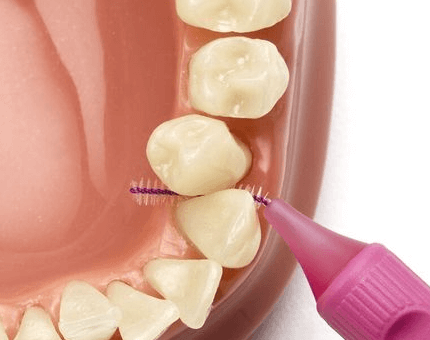 잇몸 염증 예방을 위한 치간 칫솔 사용도 추천