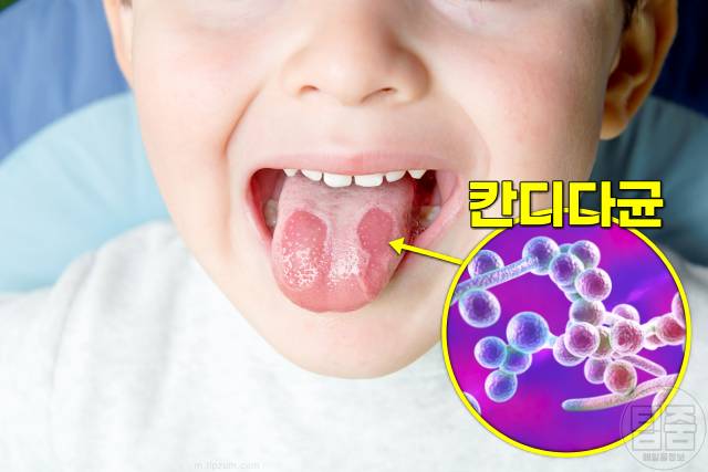 입이 떫은 증상 혀가 화끈거려요 구강작열감증후군 원인 칸디다균