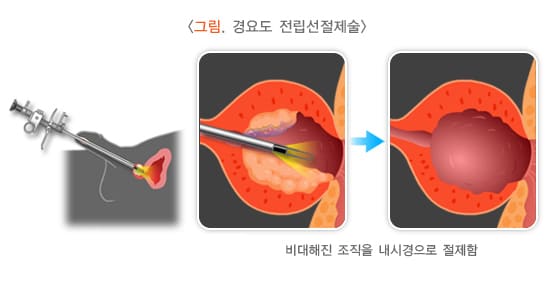 전립선비대증