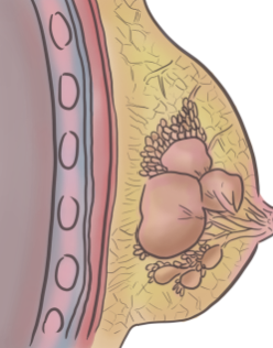 유방암 2기 생존율