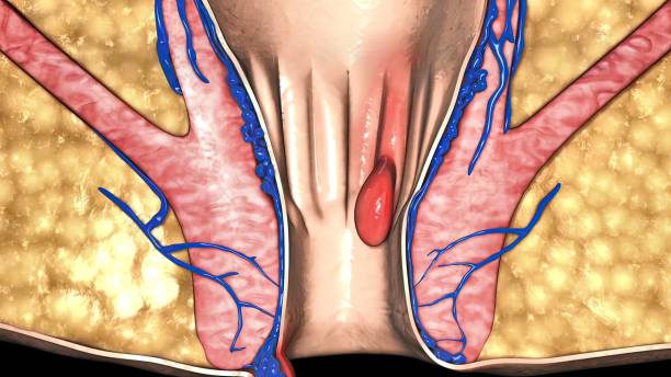 항문에서 피가나는 이유 자세히 26