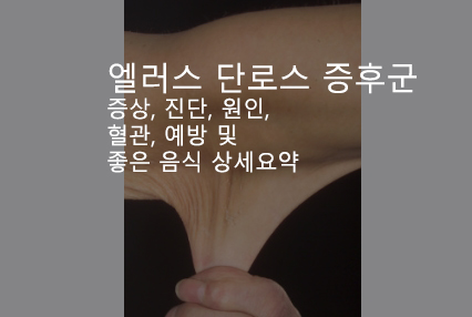 엘러스 단로스 증후군 증상, 진단, 원인, 혈관, 예방 및 좋은 음식 상세요약