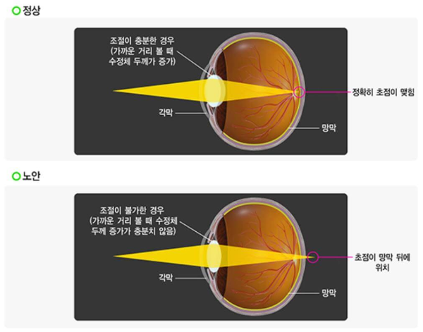 노안의_원인(출처:질병관리청)