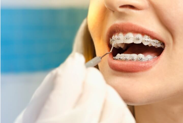 치아교정-치료-중