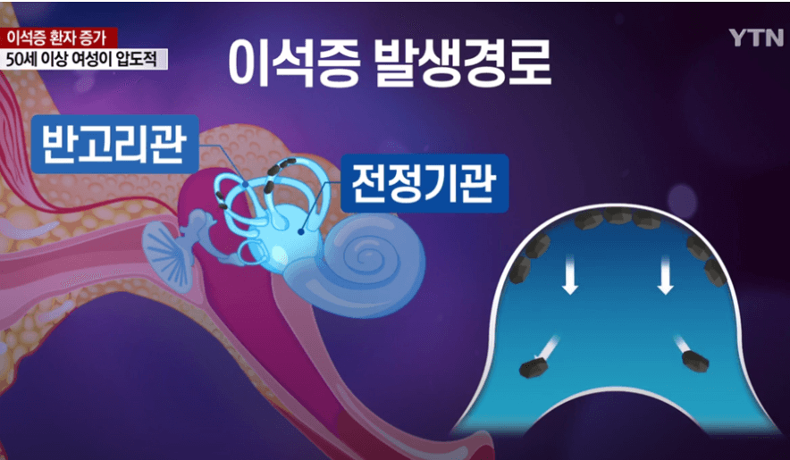 이석증은 내이안에 있는 이석이 어떤이유로든 원래 위치에서 떨어져나와 반고리관 내부에 흘러다니면서 생기는 질환입니다.