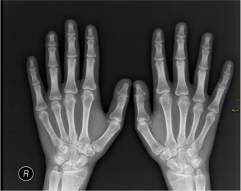 X-ray-손-사진