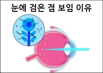 눈에 검은 점 보임 이유