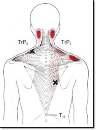 승모근의 통증유발점을 나타낸 그림