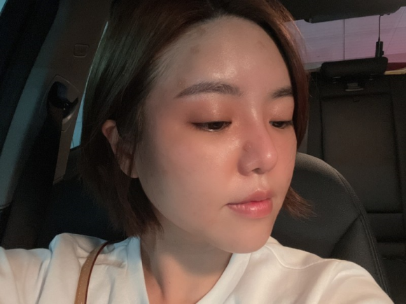 이마필러잘하는곳 후기! 13