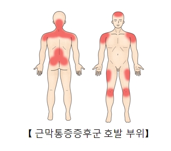  근육통증이론-3