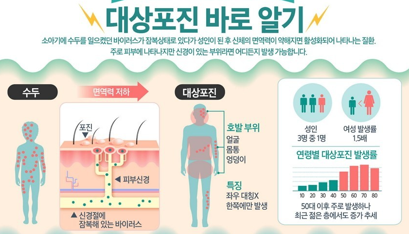  대상포진 초기증상 치료방법은?
