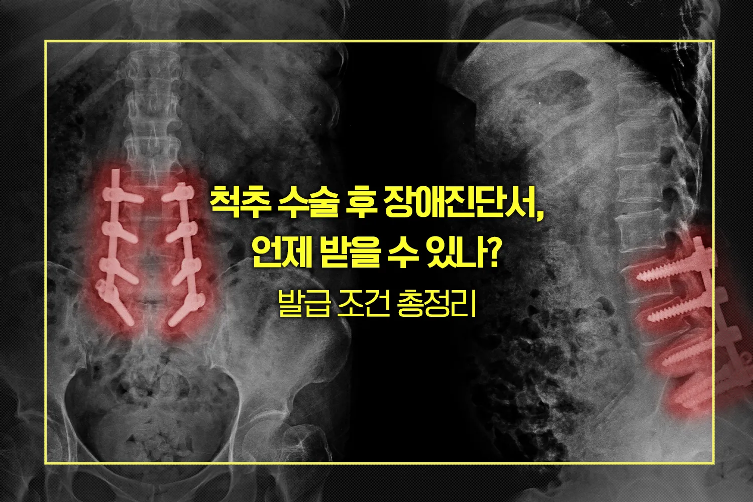 척추-수술-장애진단서-발급