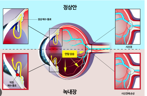 녹내장, 조기 발견 치료