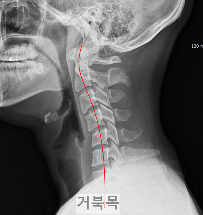 경추-거북목