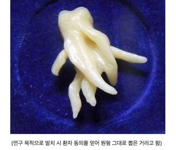  전생에 나라를 많이 팔아먹은 사람의 사랑니