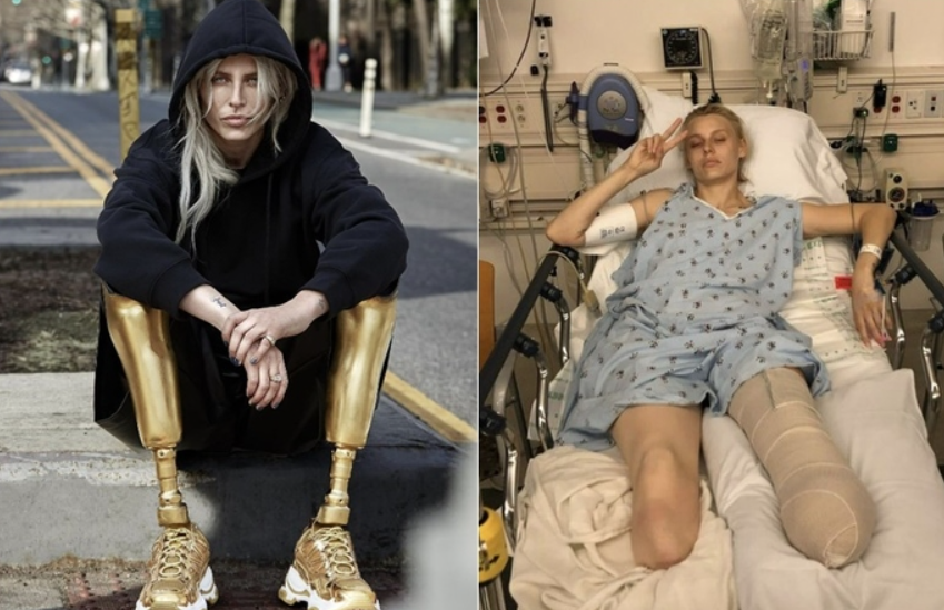 독성 쇼크 증후군 3