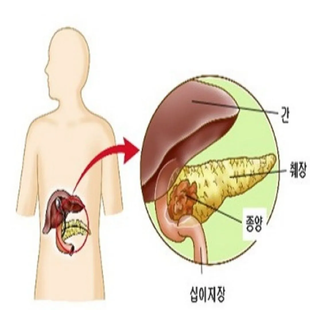 췌장암 초기증상 및 췌장암 원인