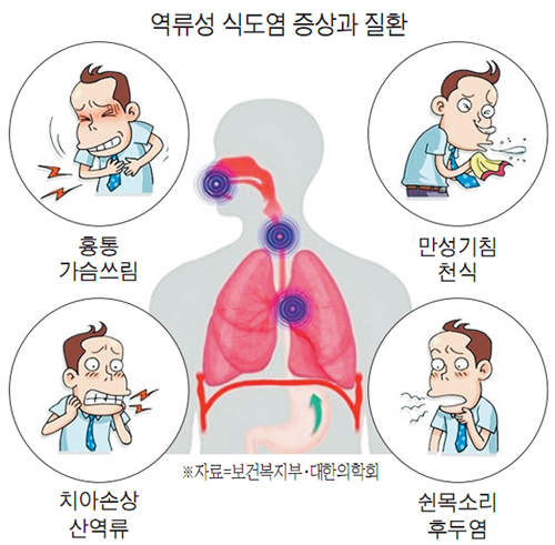 역류성식도염